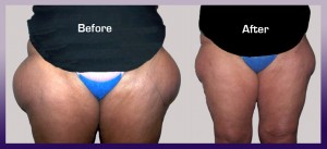 ThighsBefore&After Thighs before & after laser lipo