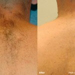 Laser Hair Removal - Before and After