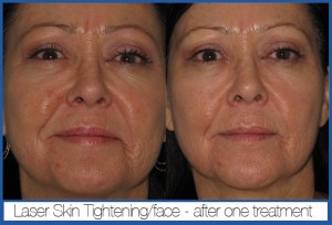 Laser Skin Tightening- before and after- St Louis Lipo, Dr. Wright