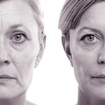 before and after injection with Voluma filler