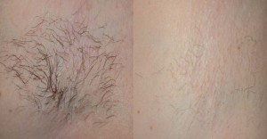 St Louis Laser Liposuction Center- Diolaze Laser