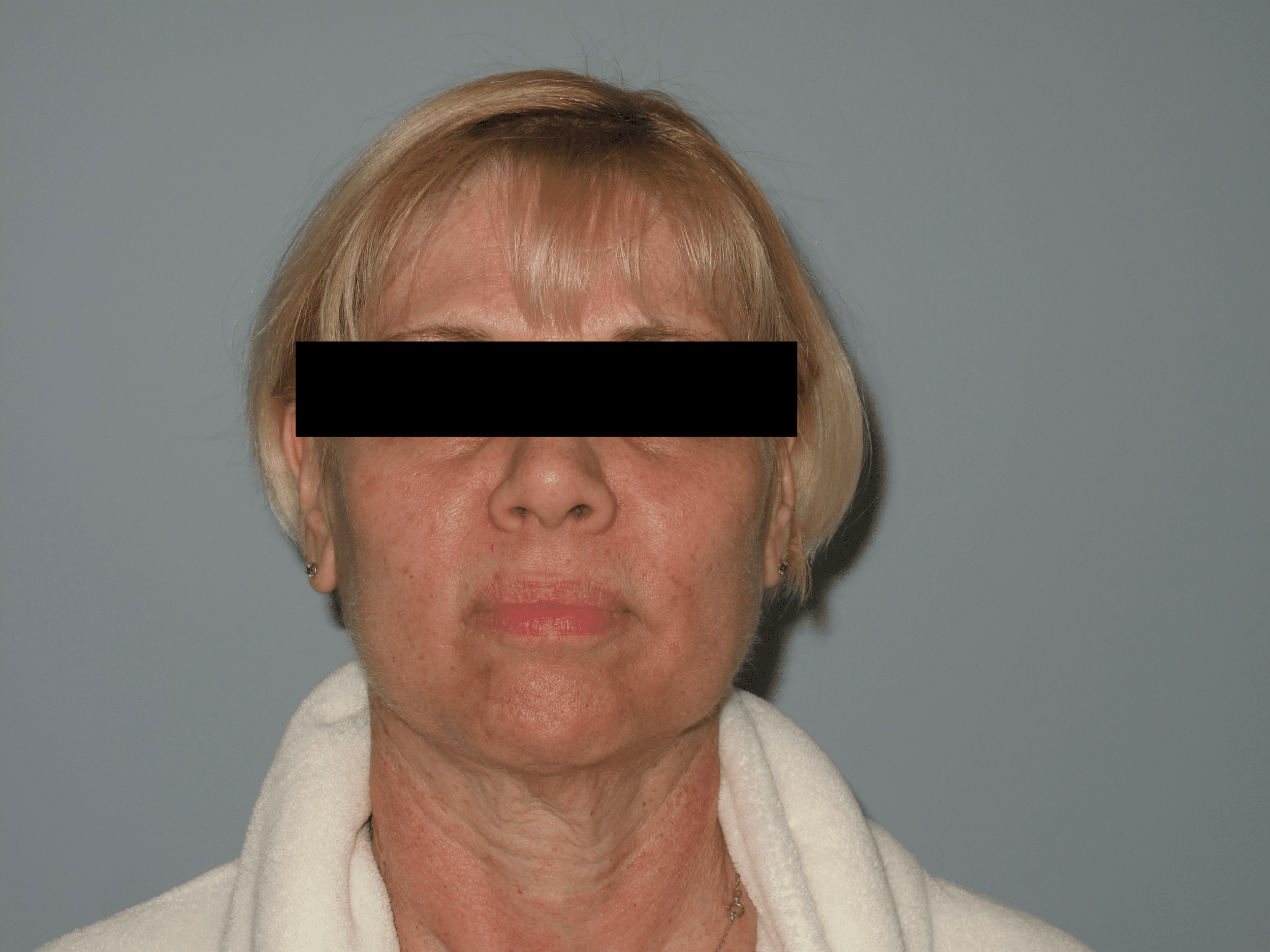 anterior face after min