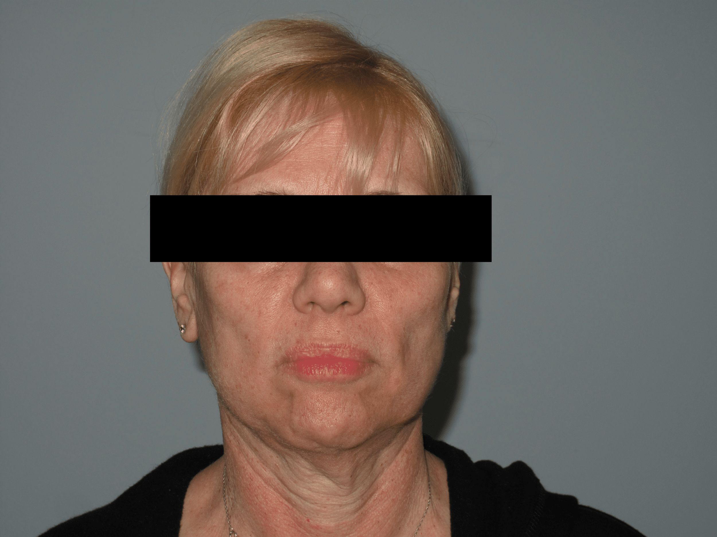 anterior face before min