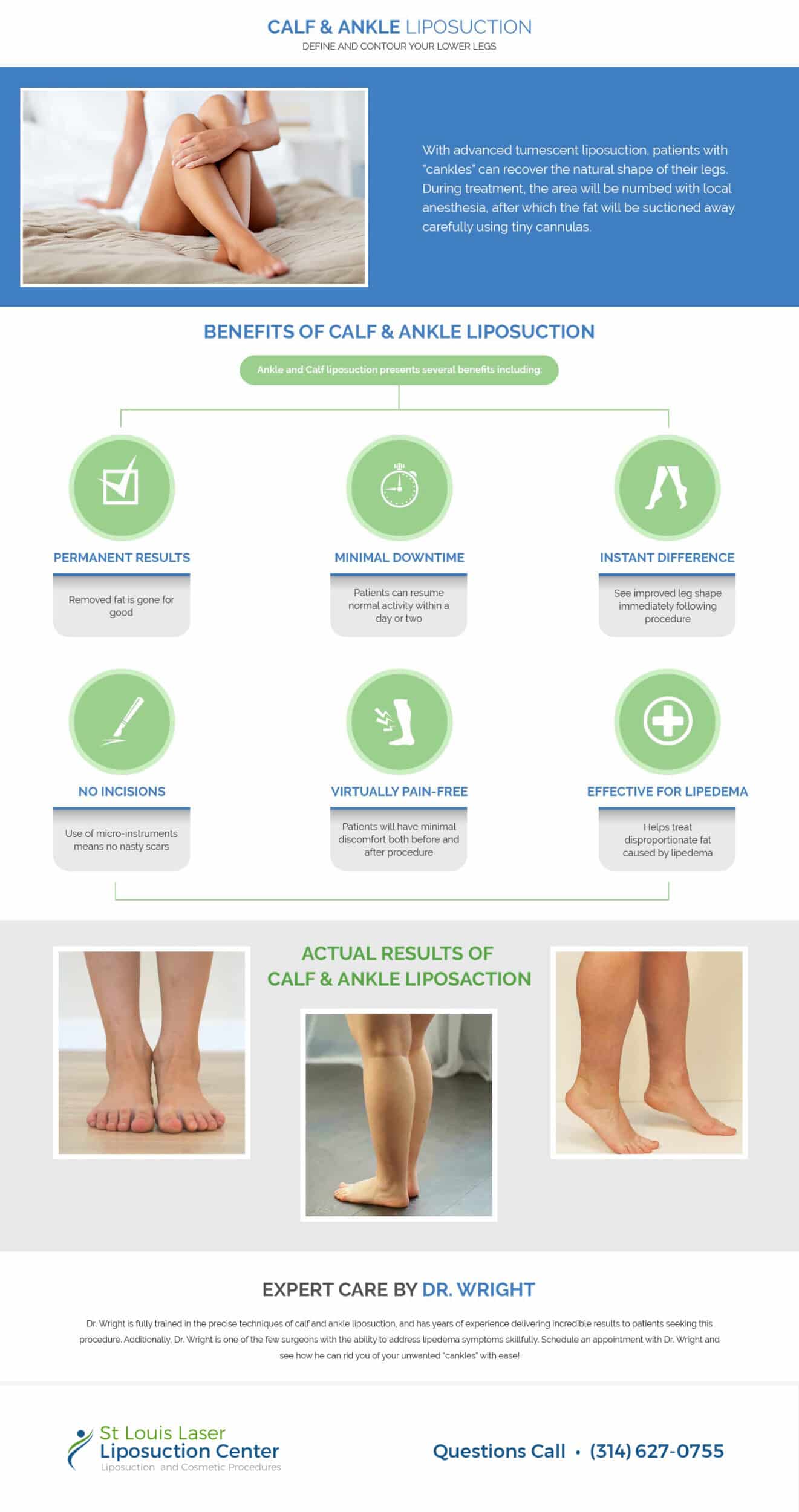 SLLC Calf and Ankle Lipo