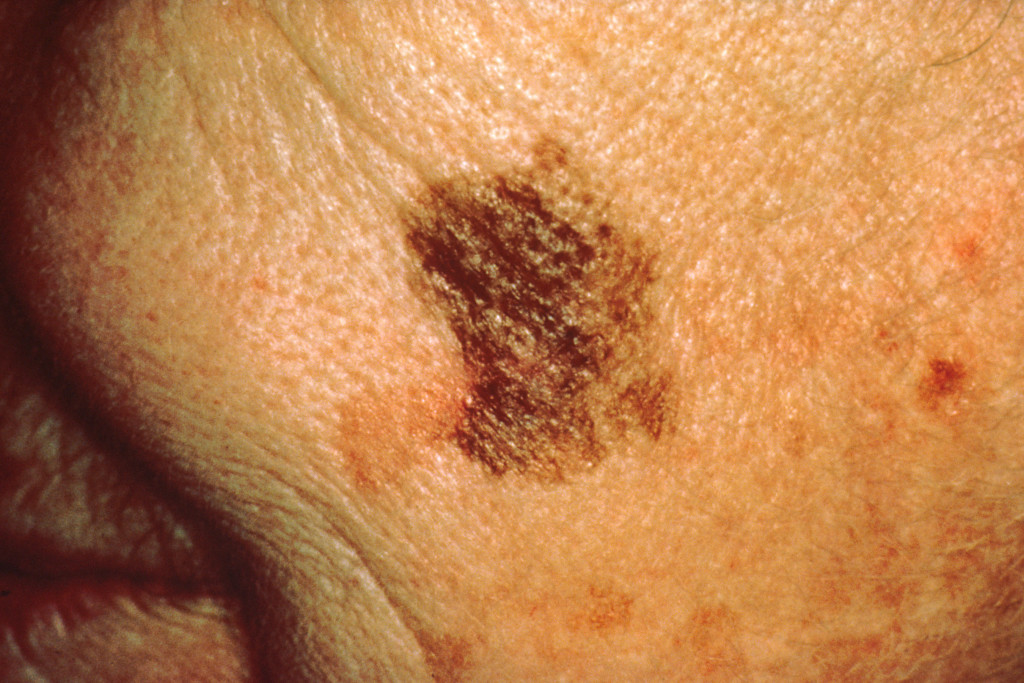 Melanoma_with_diameter_change