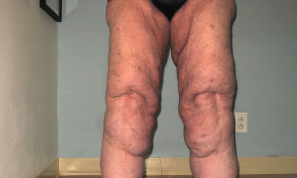 lipedema1