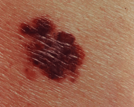 MELANOMA