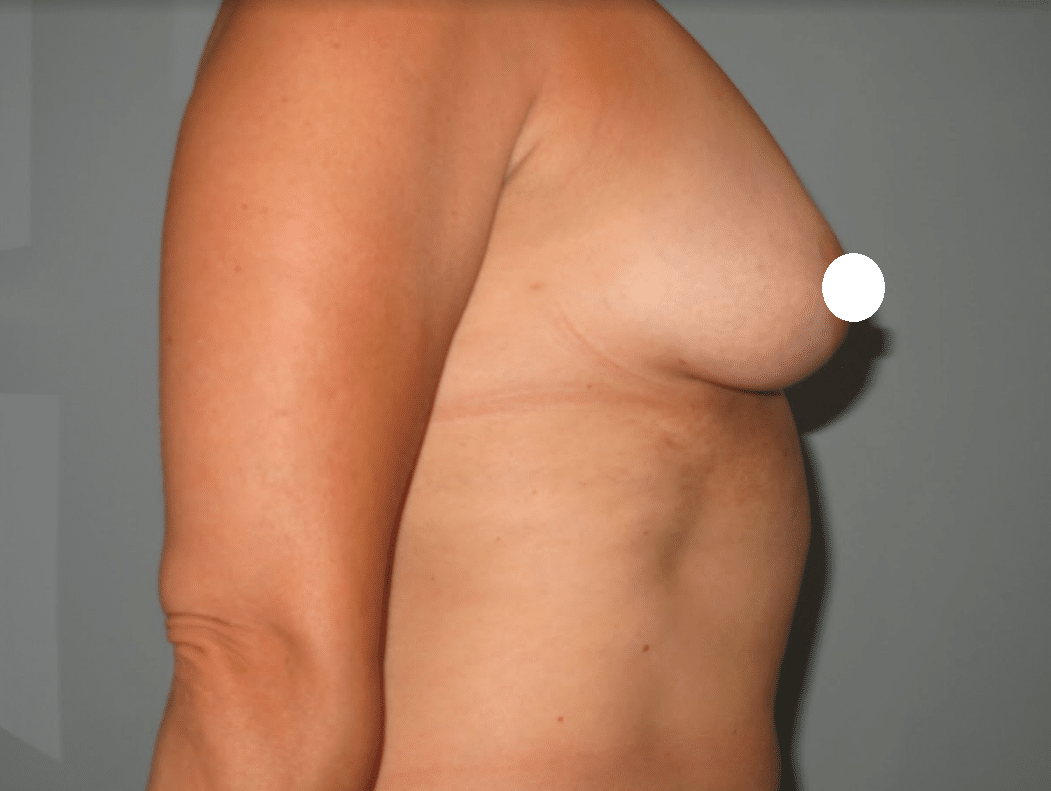 breastafter1