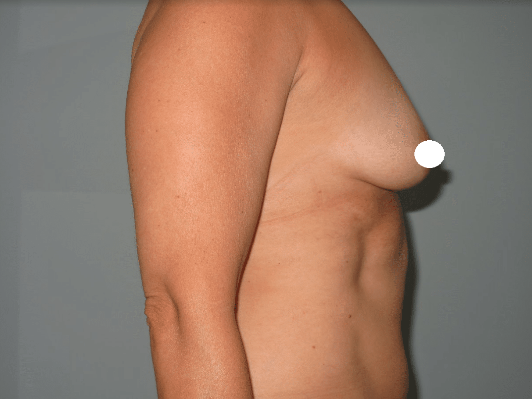 breastbefore1