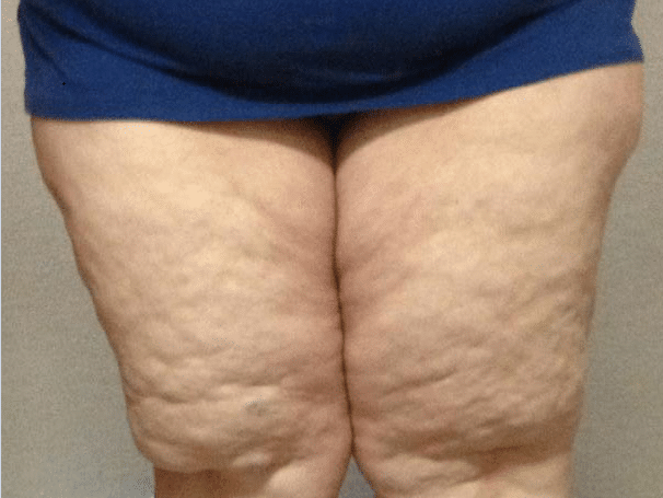 lipedema