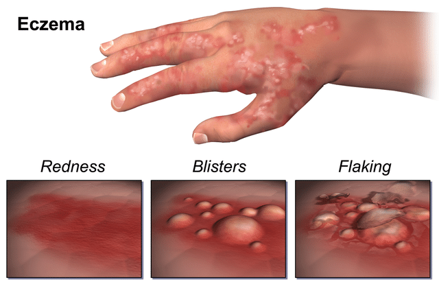 640px eczema