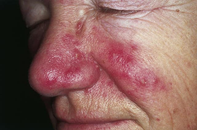 640px rosacea 01