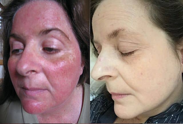 Rosacea