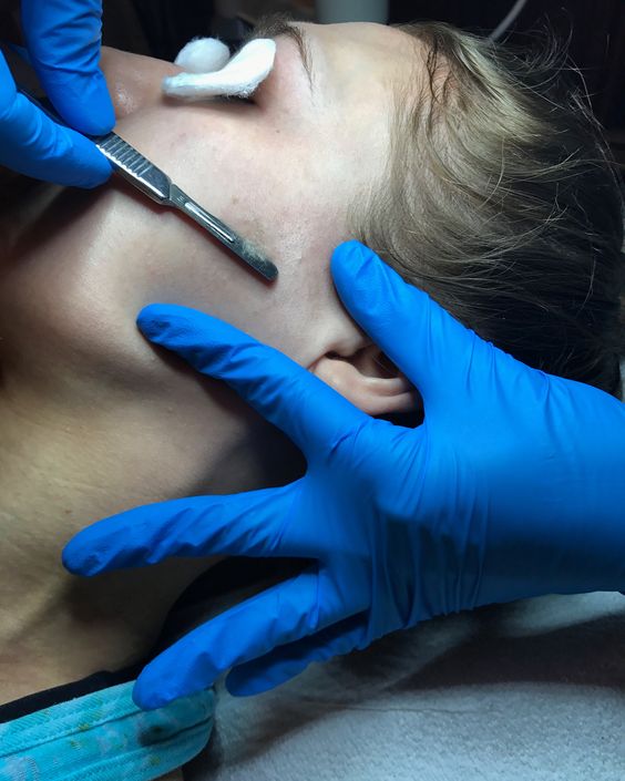 Dermaplaning St Louis