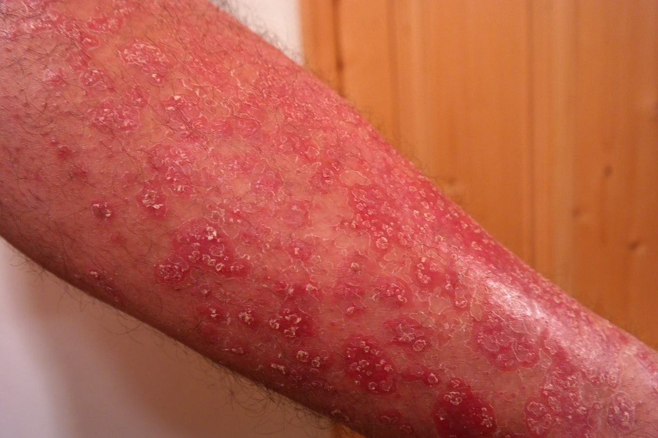 psoriasis 356429 1280