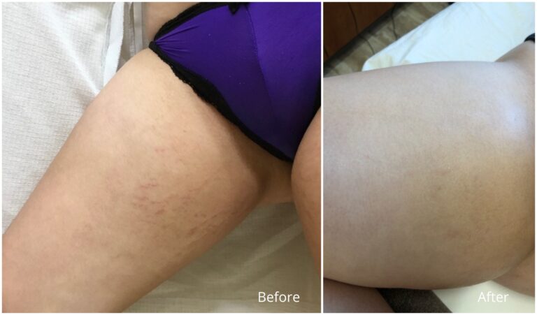 stretch marks collage