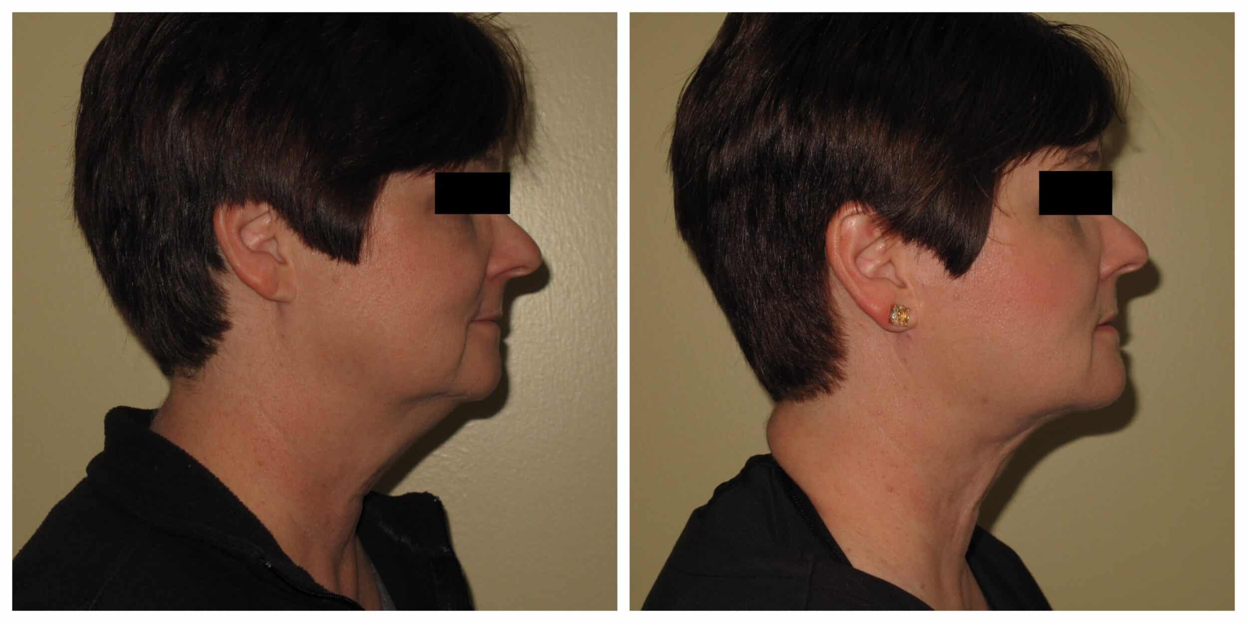chin lipo before and after