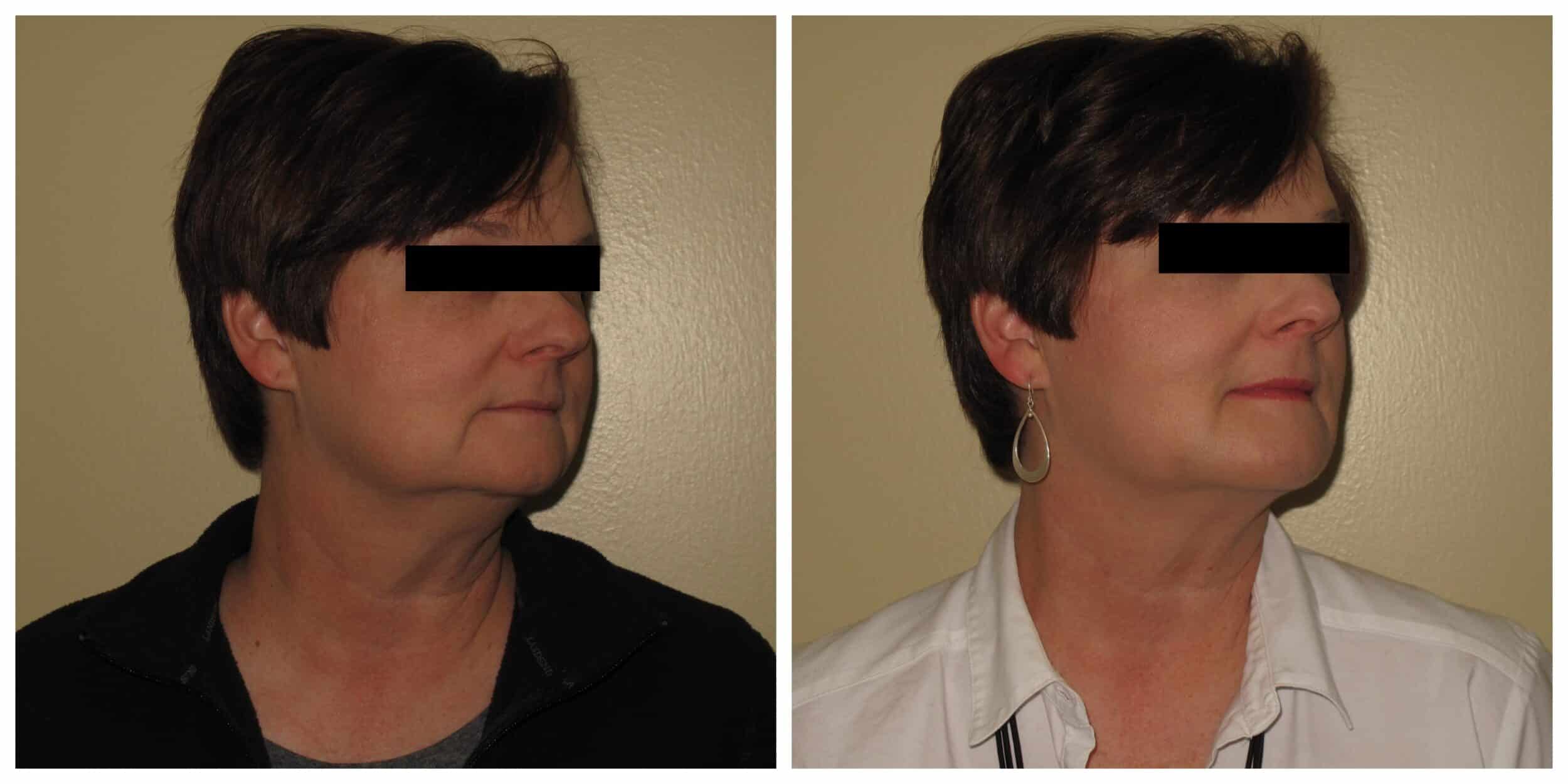 chin liposuction before and after