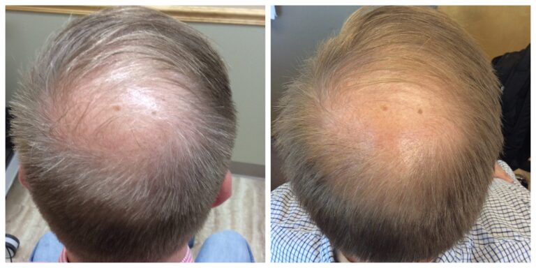 prp hair loss before and after