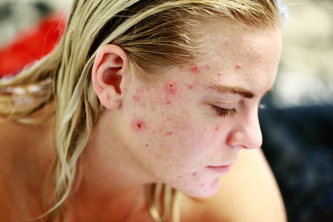 acne treatment