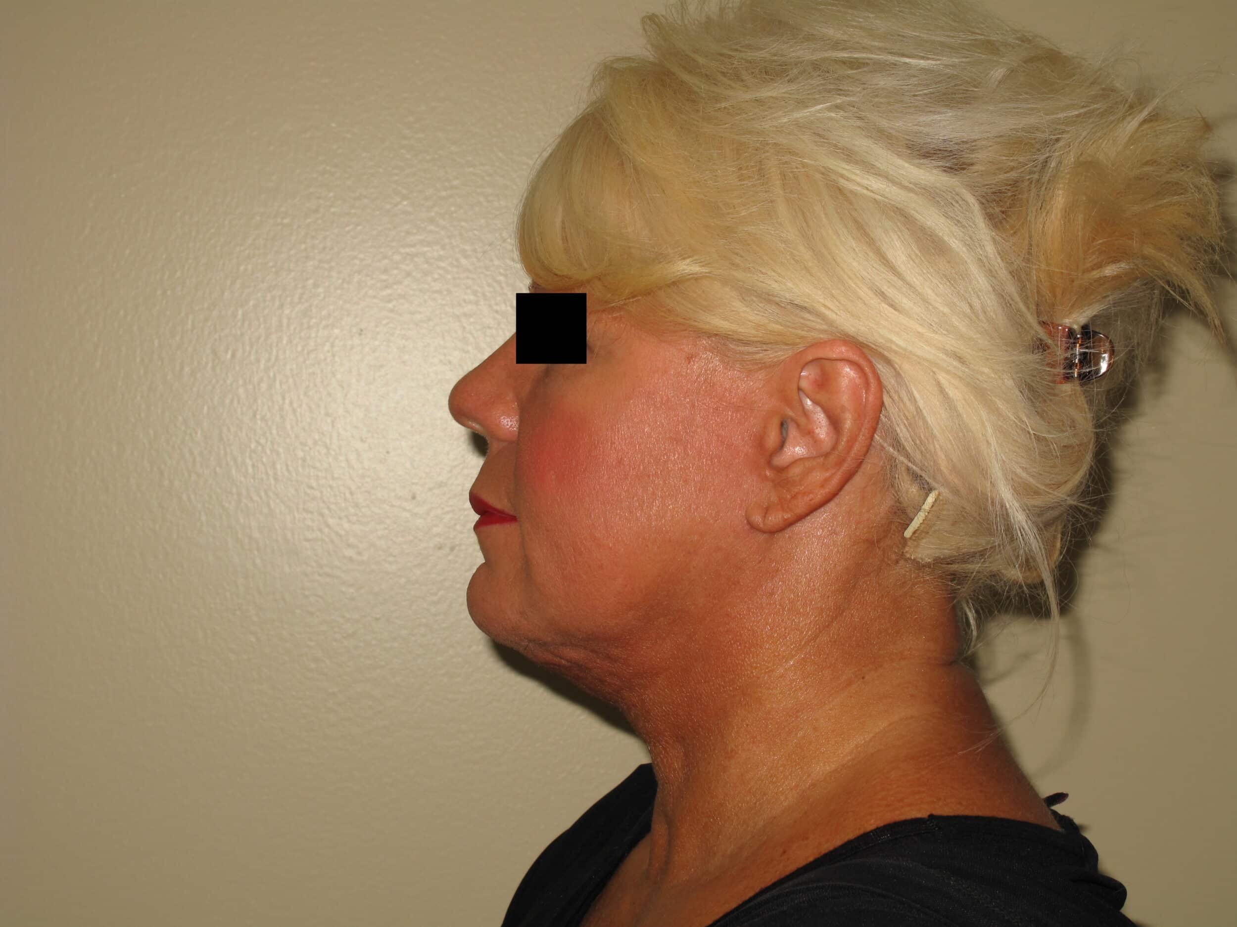 HAR R BEFORE AND AFTER010