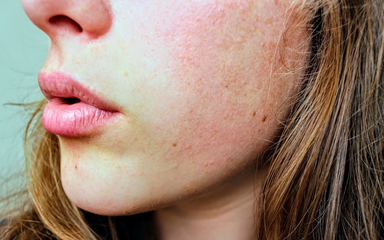 Winter skin care