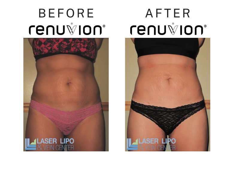 Before After Renuvion St Louis Skin Tightening