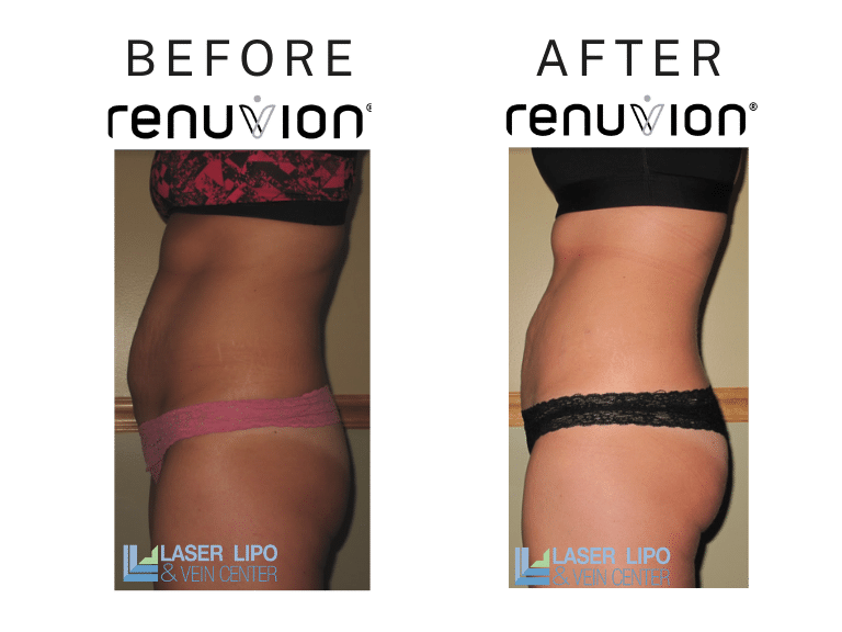 Before After Renuvion St Louis Skin Tightening