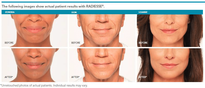 Radiesse Facial Fillers Before After