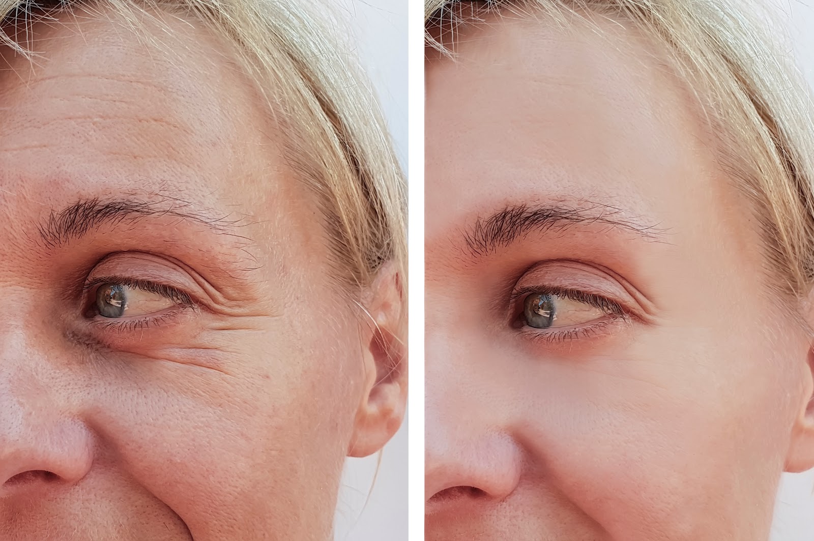 Woman after a procedure to remove eye wrinkles