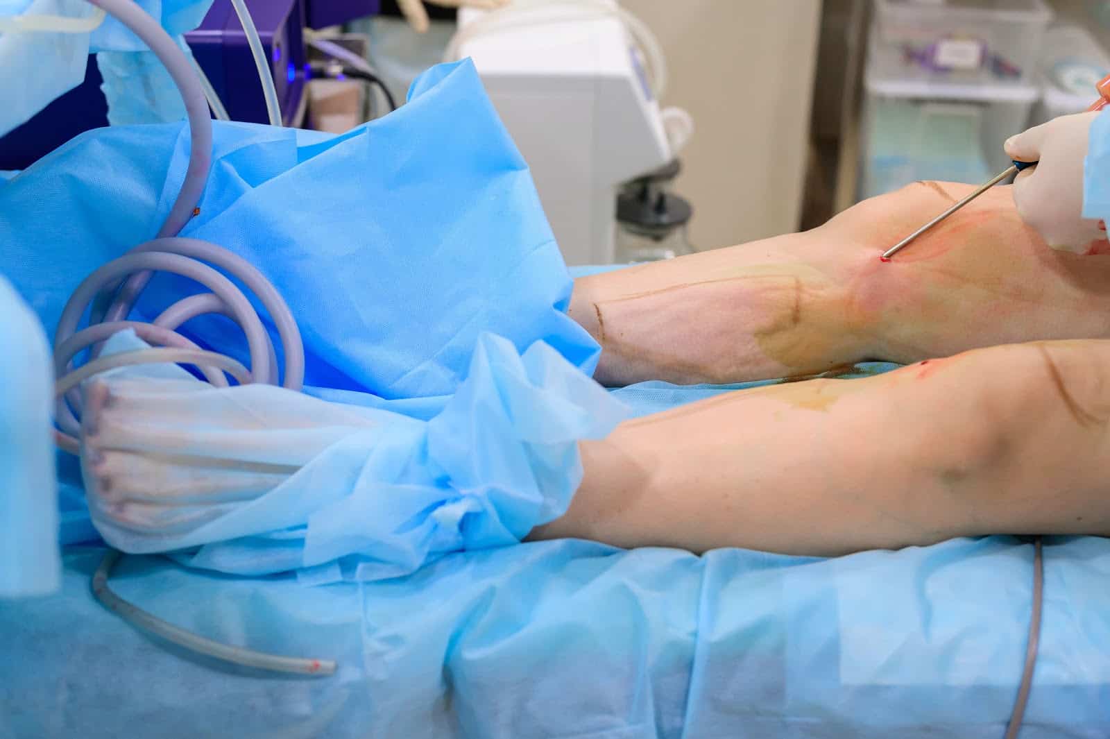 Cosmetic surgery liposuction. The process of removing fat on the legs of a fat woman. Without face, unrecognizable patient.