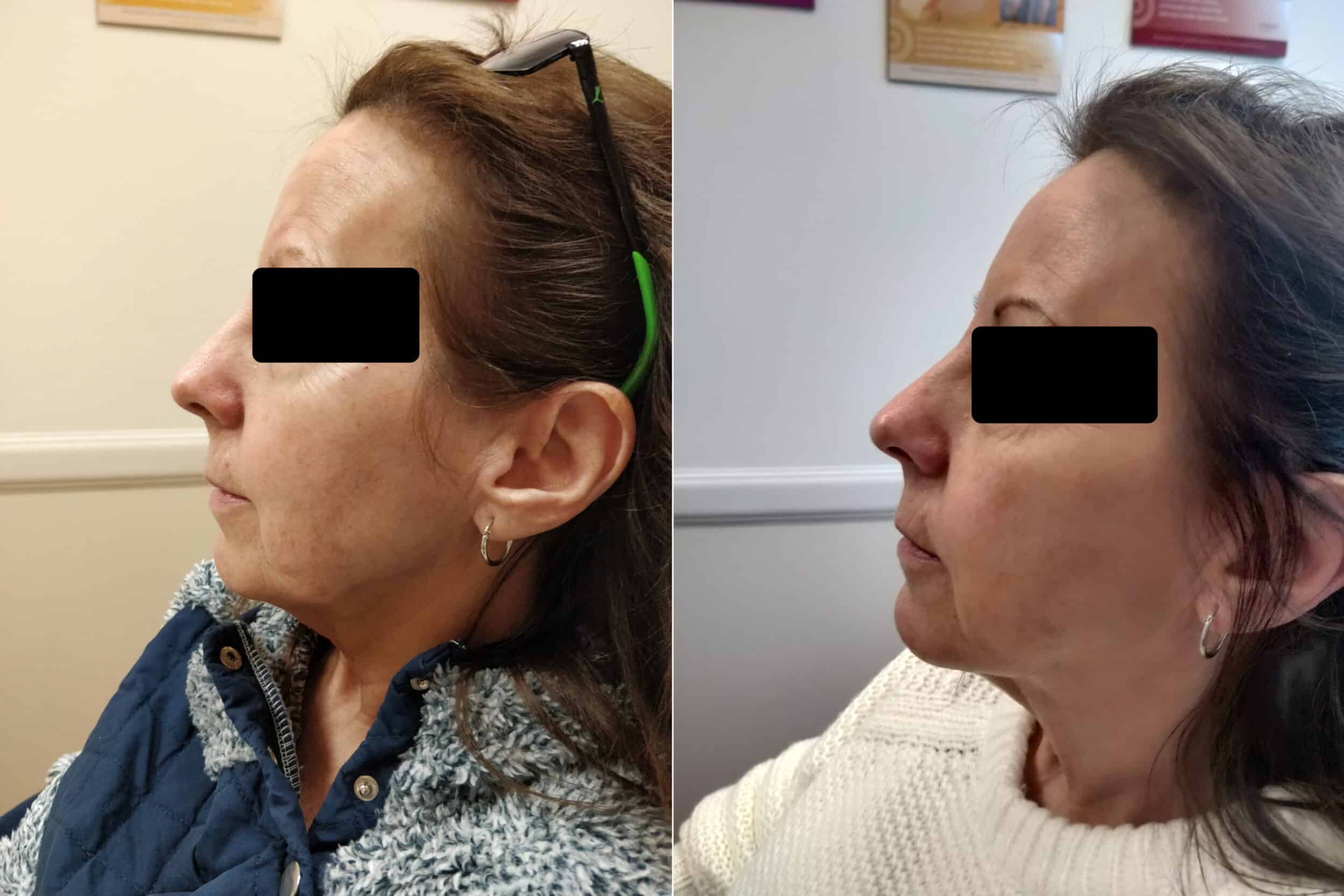 Jawline Filler Before and After