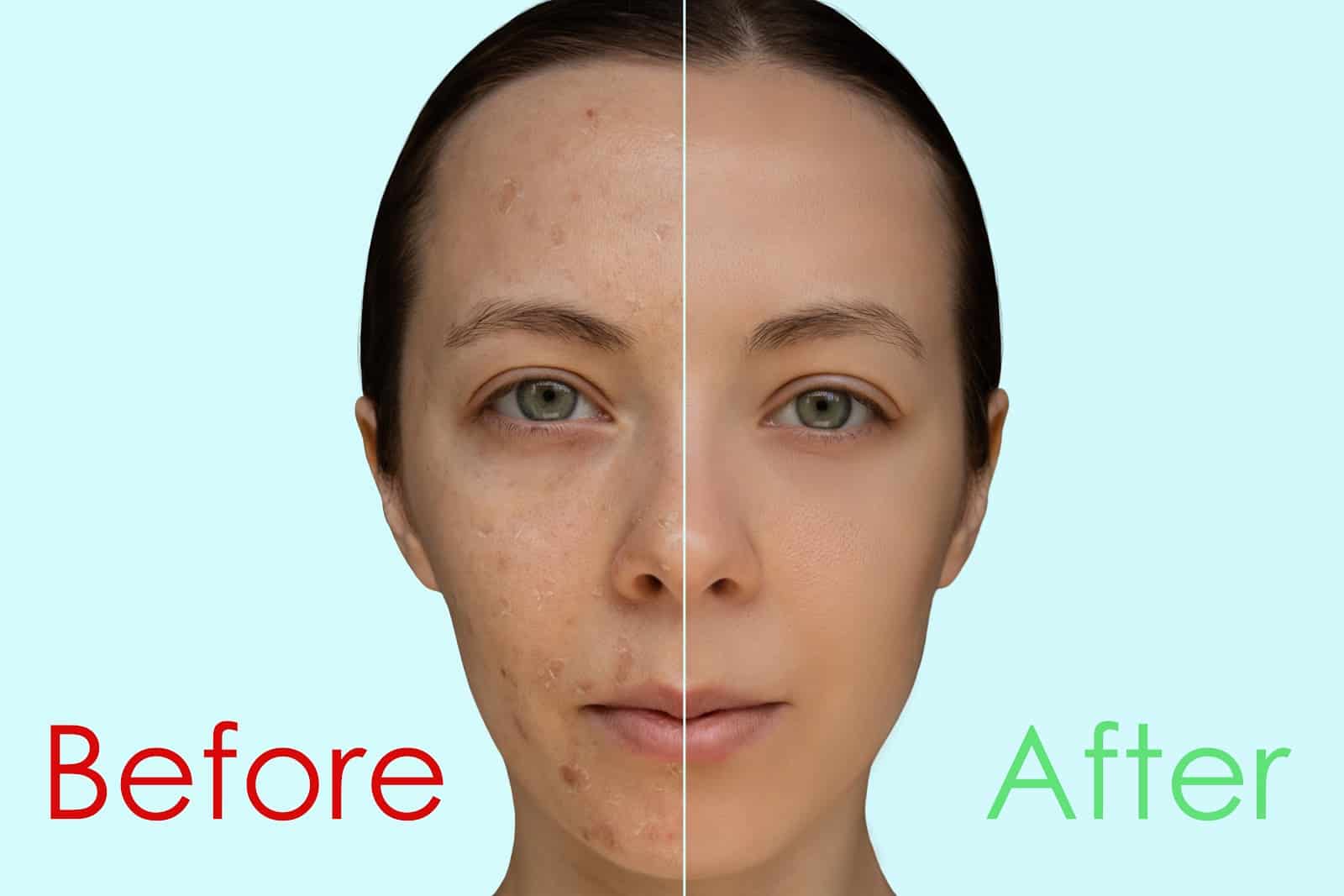 Before and After Chemical Exfoliation