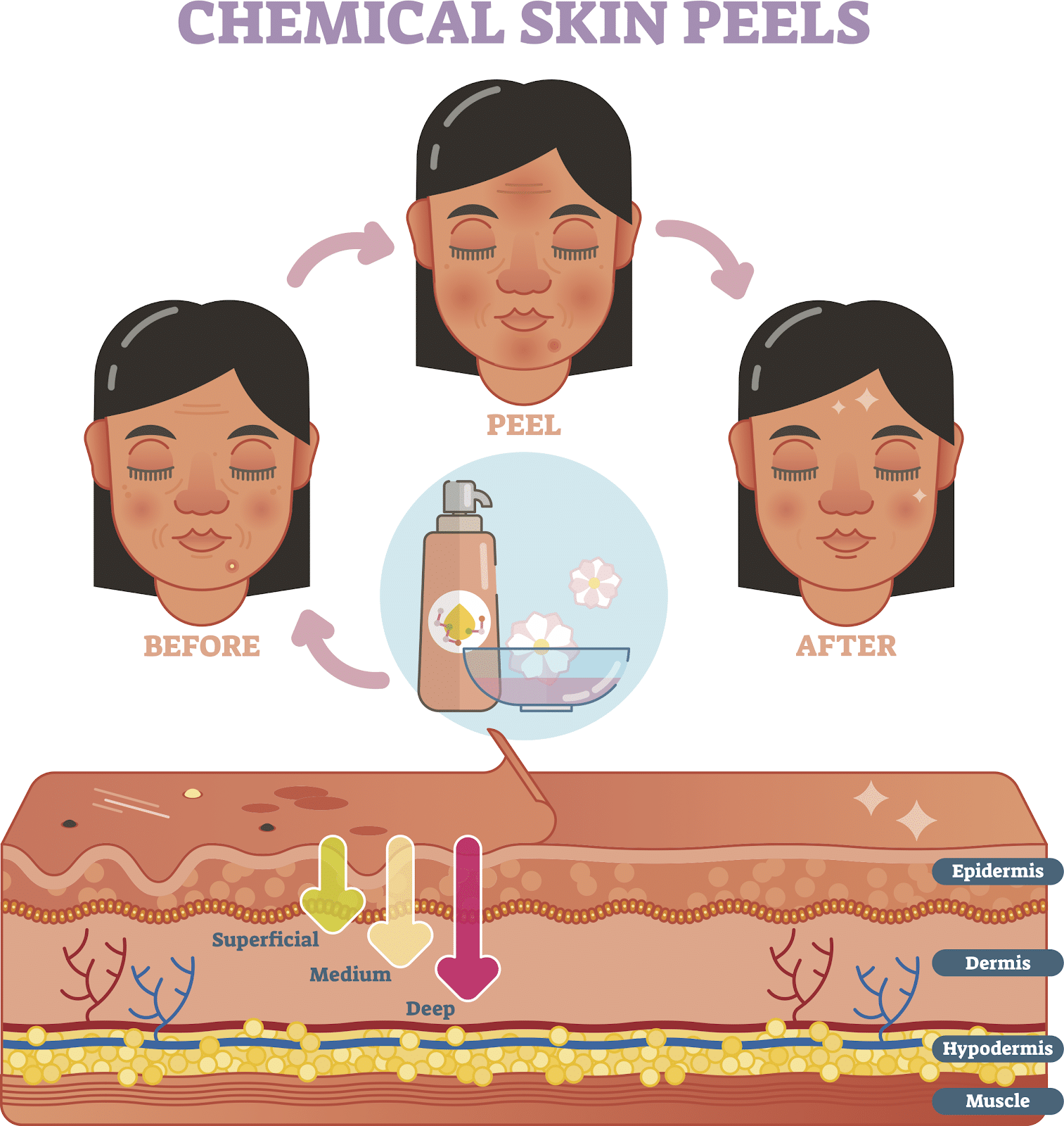 Chemical Skin Peel Infographic