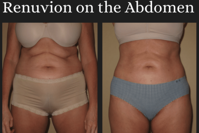 Abdomen Renuvion Before and After