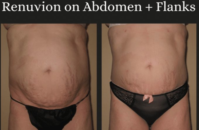 Beofre and After Abs Renuvion