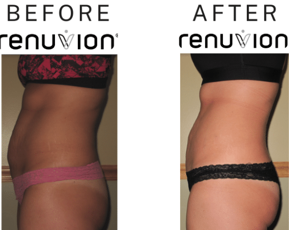 Before and After Renuvion on Abdomen