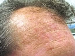 sun damage