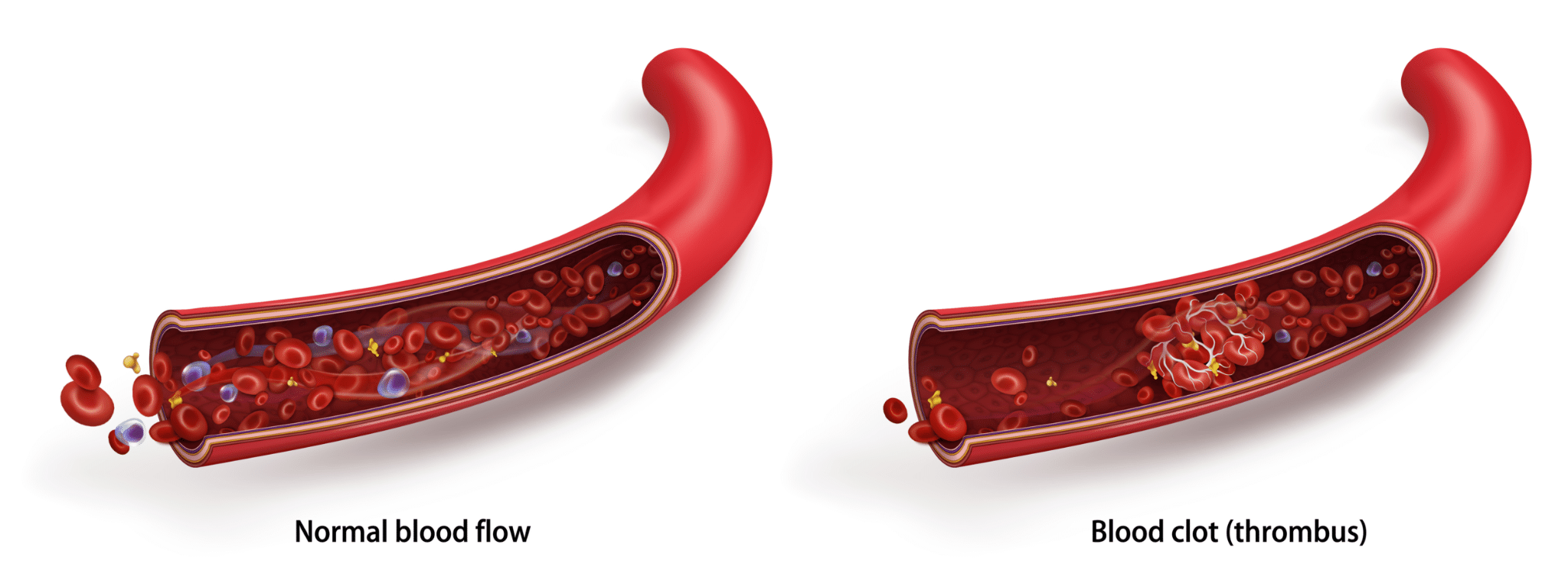 deep vein thrombosis