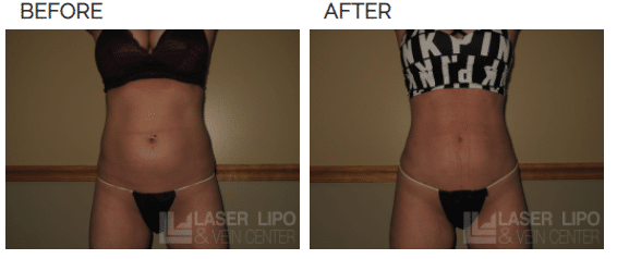 super lipo