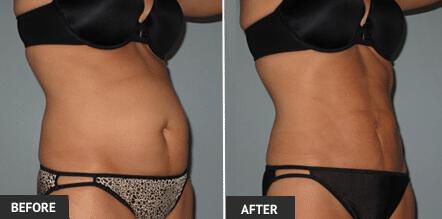 tumescent lipo
