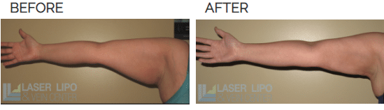 super lipo