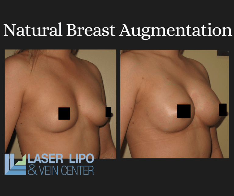 Fat Transfer Before & After (1)