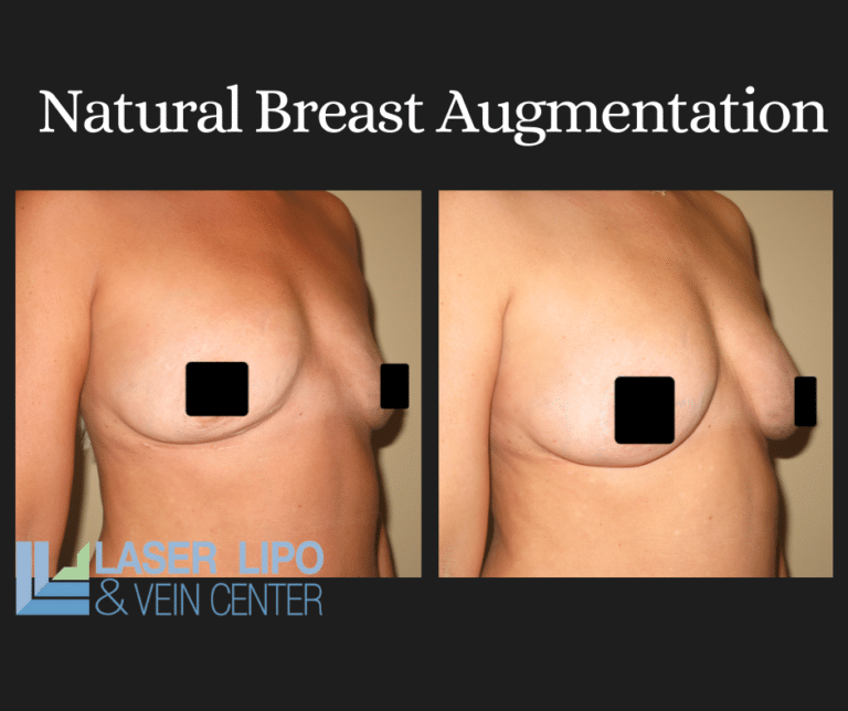 Fat Transfer Before & After (2)