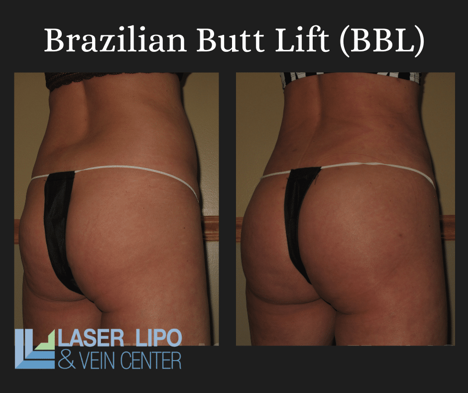 Fat Transfer Before & After (3)