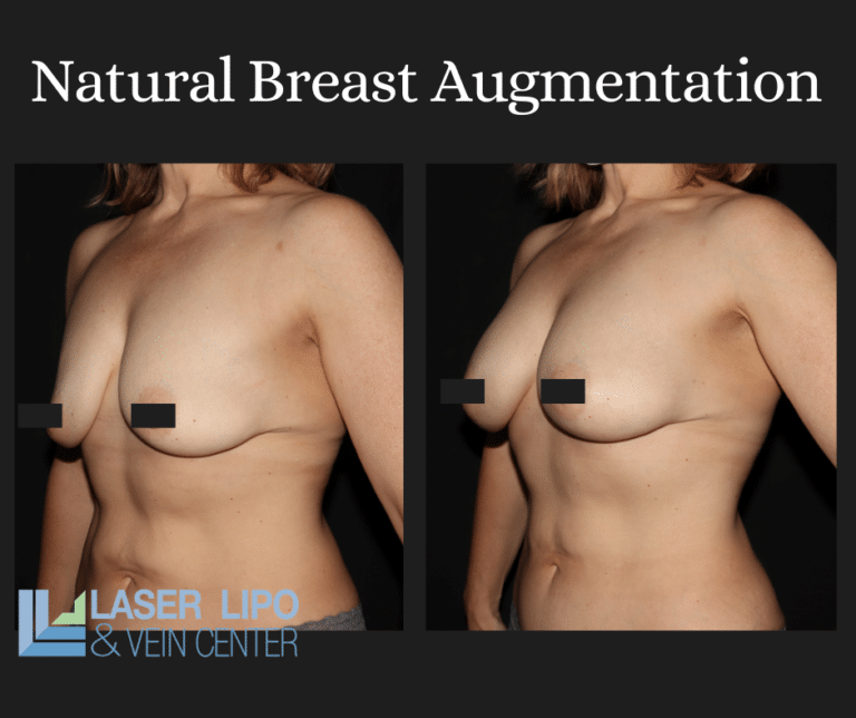 Fat Transfer Before & After