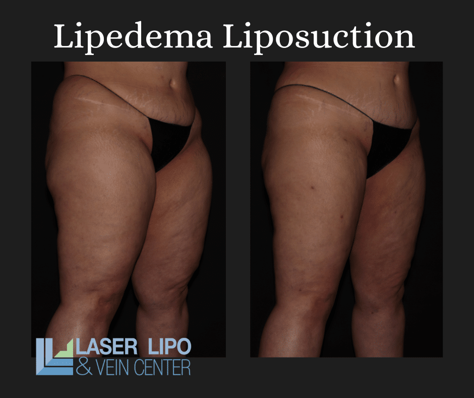 Lipedema Before and After