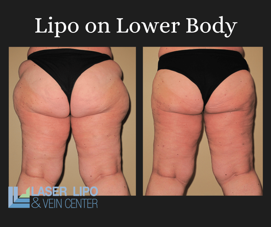 Liposuction Before & After (1)