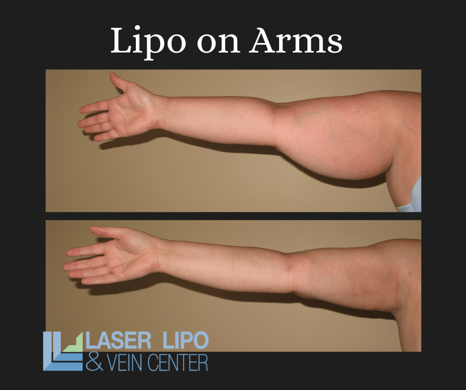 Liposuction Before & After (2)