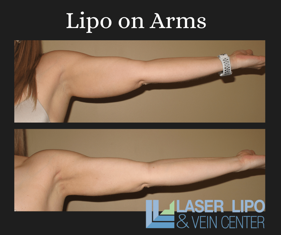 Liposuction Before & After (3)